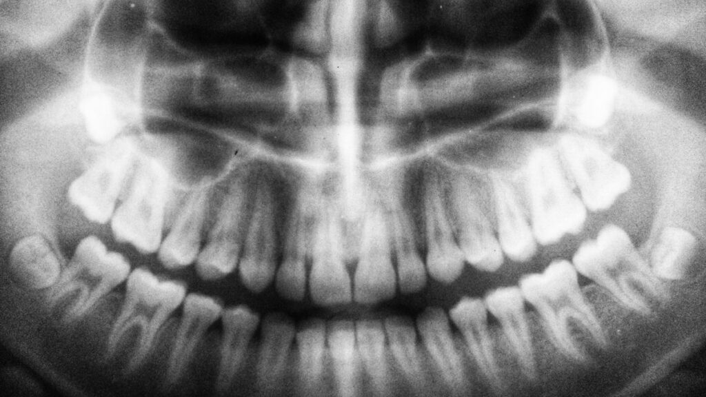 teeth X-ray